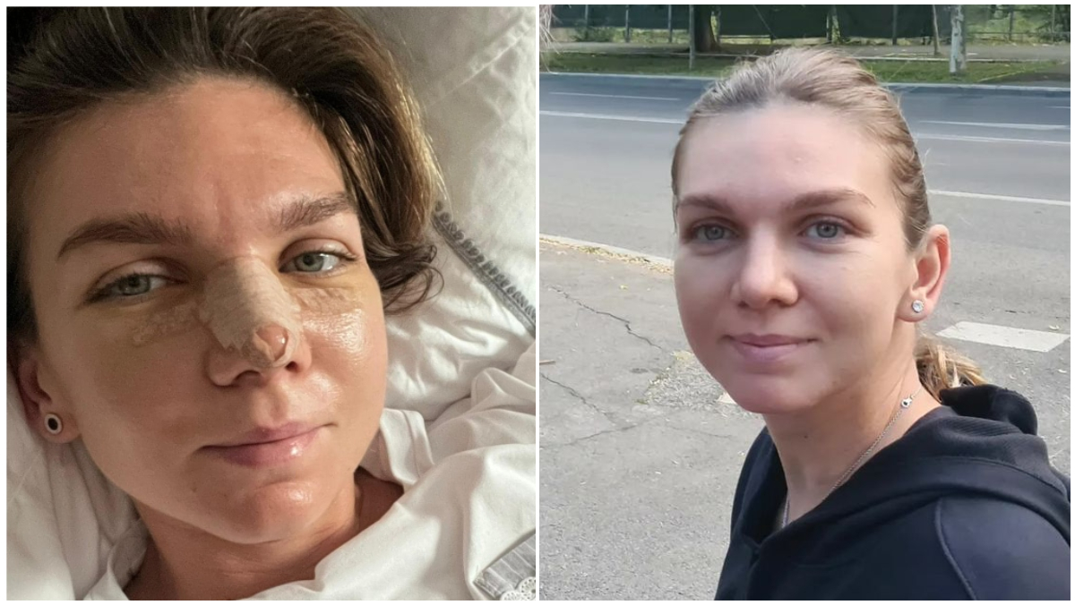 Simona Halep transformare demențială Cum arată noul nas al sportivei